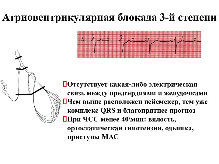 Атриовентрикулярная блокада 3-й степени Отсутствует какая-либо электрическая связь между предсердиями