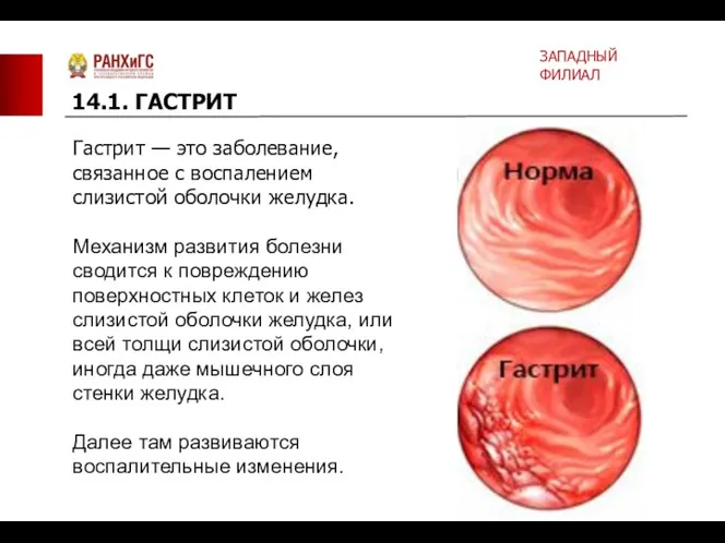 Гастрит — это заболевание, связанное с воспалением слизистой оболочки желудка.