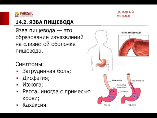 Язва пищевода — это образование изъязвлений на слизистой оболочке пищевода.