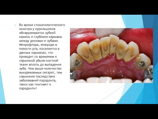 Во время стоматологического осмотра у курильщиков обнаруживается зубной камень и глубокие карманы между