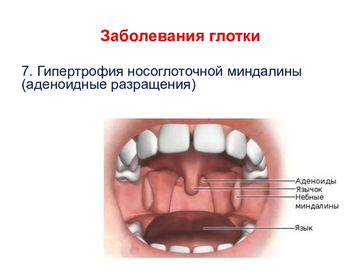 Заболевания глотки 7. Гипертрофия носоглоточной миндалины (аденоидные разращения)