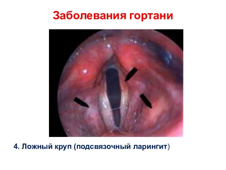 Заболевания гортани 4. Ложный круп (подсвязочный ларингит)