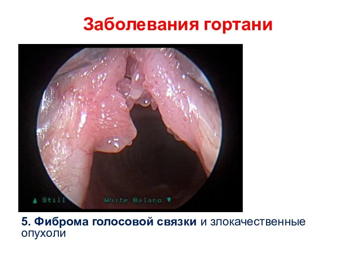 Заболевания гортани 5. Фиброма голосовой связки и злокачественные опухоли
