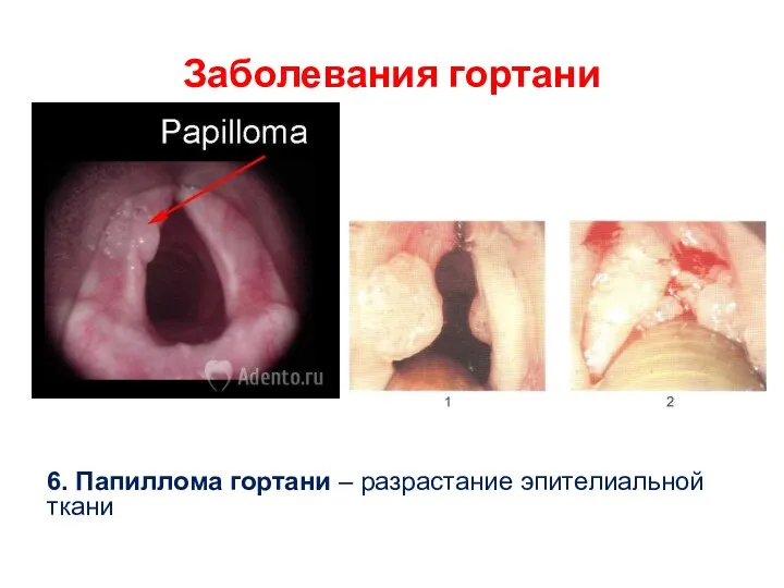 Заболевания гортани 6. Папиллома гортани – разрастание эпителиальной ткани