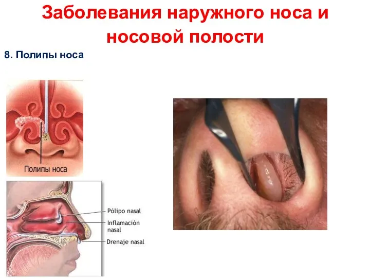 Заболевания наружного носа и носовой полости 8. Полипы носа