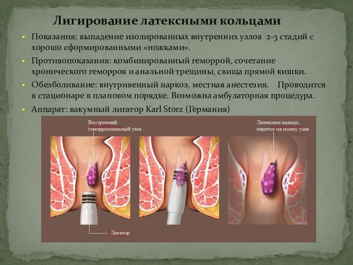 Лигирование латексными кольцами Показания: выпадение изолированных внутренних узлов 2-3 стадий