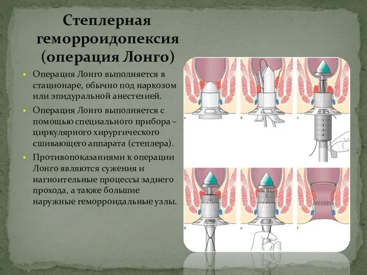 Степлерная геморроидопексия (операция Лонго) Операция Лонго выполняется в стационаре, обычно под наркозом или