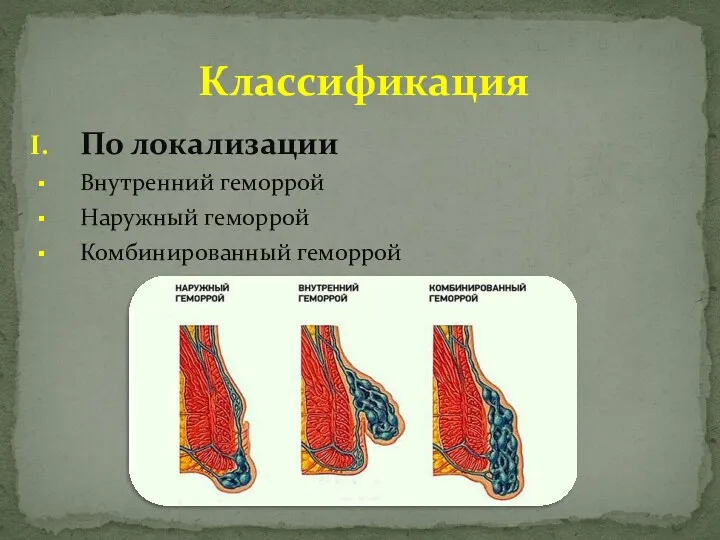 По локализации Внутренний геморрой Наружный геморрой Комбинированный геморрой Классификация