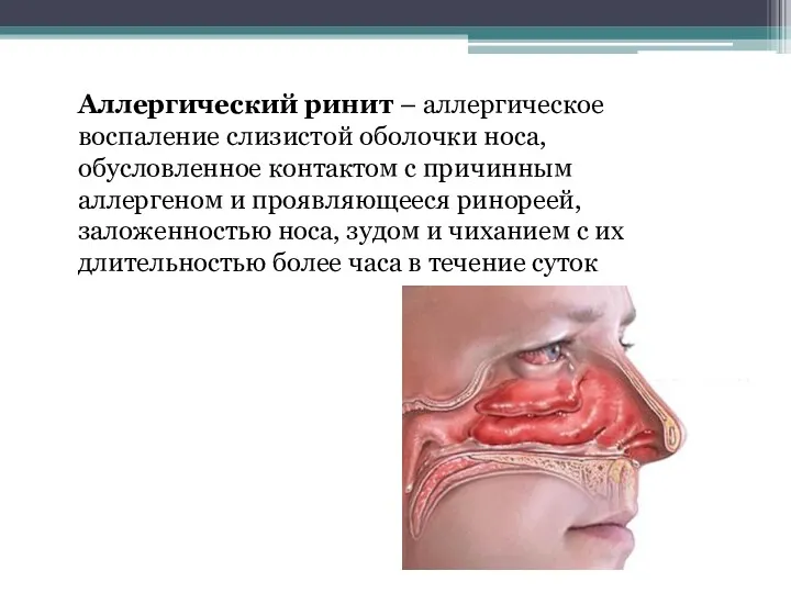 Аллергический ринит – аллергическое воспаление слизистой оболочки носа, обусловленное контактом