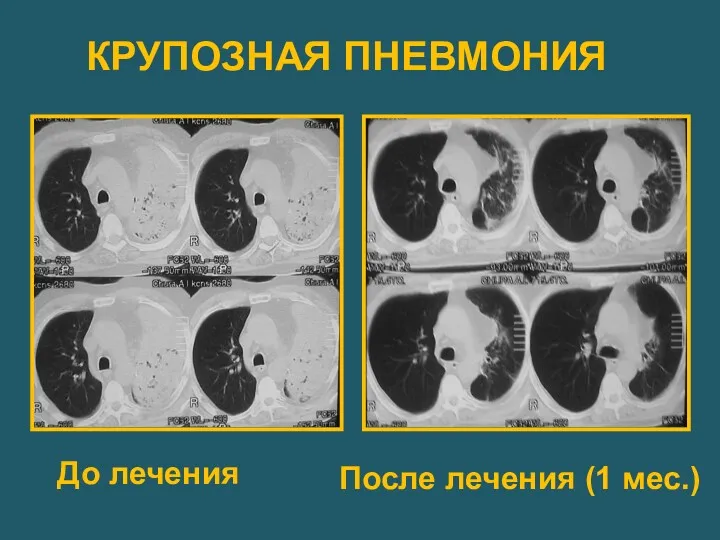 КРУПОЗНАЯ ПНЕВМОНИЯ До лечения После лечения (1 мес.)