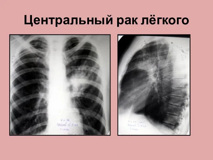 Центральный рак лёгкого