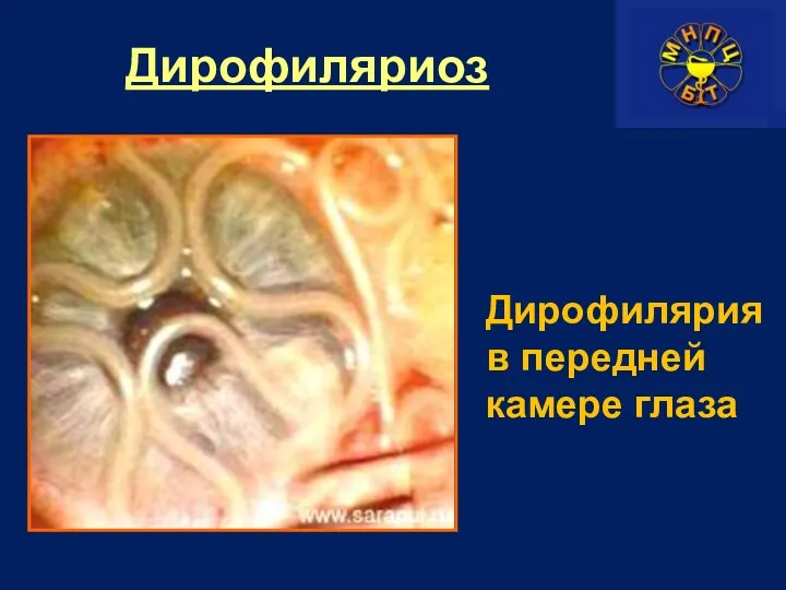 Дирофиляриоз Дирофилярия в передней камере глаза