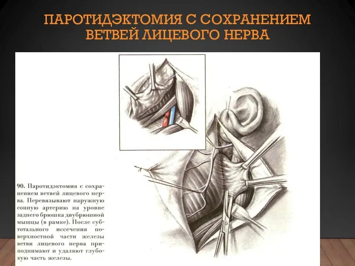 ПАРОТИДЭКТОМИЯ С СОХРАНЕНИЕМ ВЕТВЕЙ ЛИЦЕВОГО НЕРВА