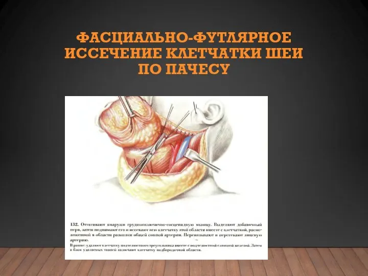 ФАСЦИАЛЬНО-ФУТЛЯРНОЕ ИССЕЧЕНИЕ КЛЕТЧАТКИ ШЕИ ПО ПАЧЕСУ