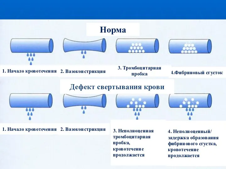 Норма 4. Неполноценный/ задержка образования фибринового сгустка, кровотечение продолжается 3.