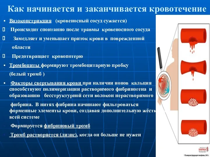 Как начинается и заканчивается кровотечение Вазоконстрикция (кровеносный сосуд сужается) Происходит