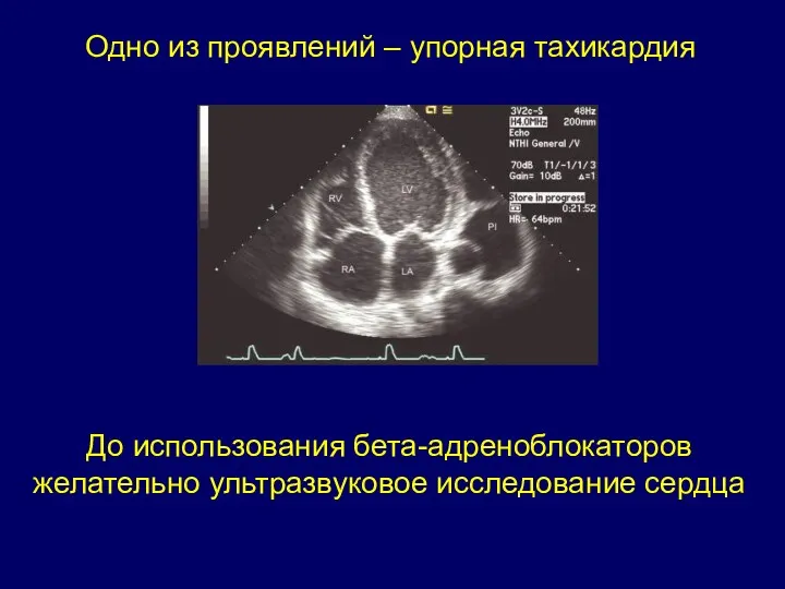 Одно из проявлений – упорная тахикардия До использования бета-адреноблокаторов желательно ультразвуковое исследование сердца