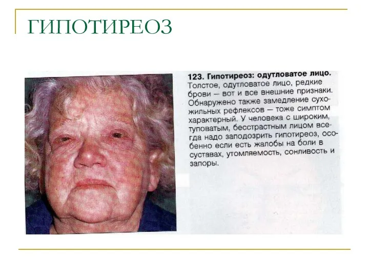 ГИПОТИРЕОЗ