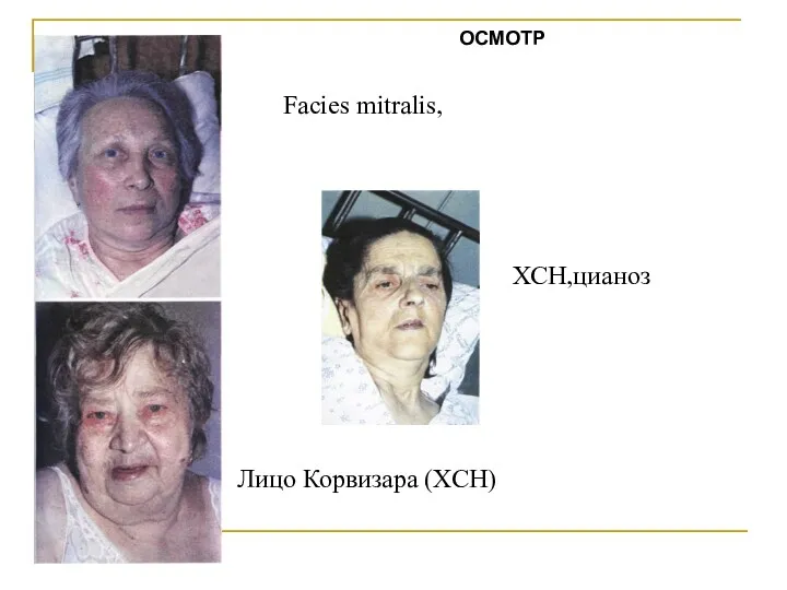 Facies mitralis, Лицо Корвизара (ХСН) ХСН,цианоз ОСМОТР