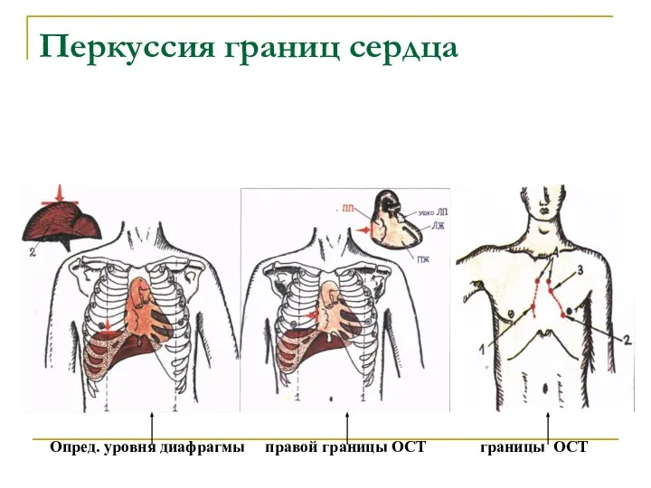 Перкуссия границ сердца Опред. уровня диафрагмы правой границы ОСТ границы ОСТ