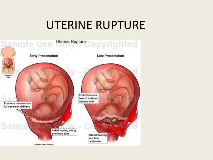 UTERINE RUPTURE