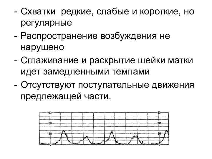 Схватки редкие, слабые и короткие, но регулярные Распространение возбуждения не