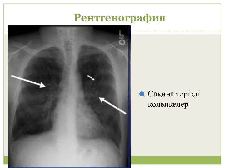 Рентгенография Сақина тәрізді көлеңкелер