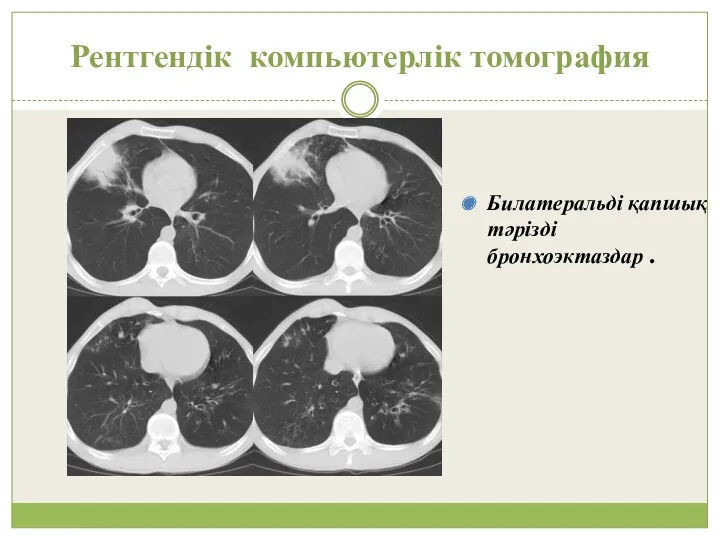 Рентгендік компьютерлік томография Билатеральді қапшық тәрізді бронхоэктаздар .