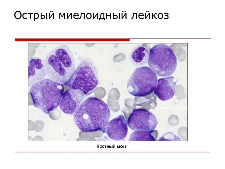 Острый миелоидный лейкоз Костный мозг