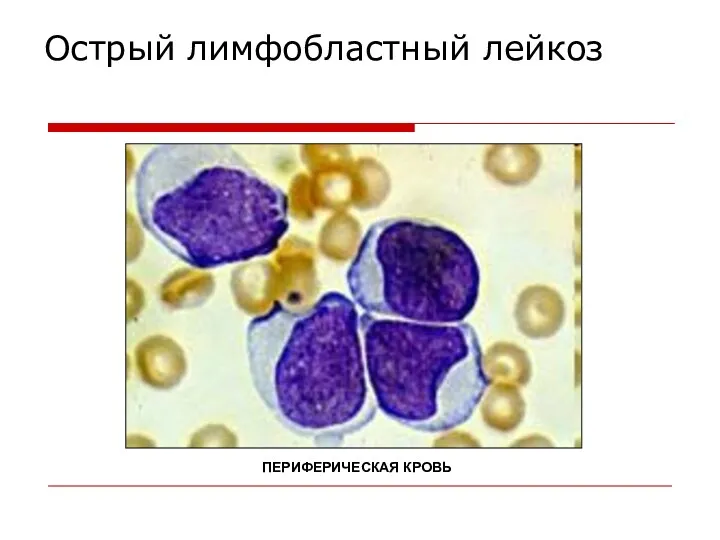 Острый лимфобластный лейкоз ПЕРИФЕРИЧЕСКАЯ КРОВЬ