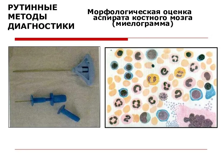 РУТИННЫЕ МЕТОДЫ ДИАГНОСТИКИ Морфологическая оценка аспирата костного мозга (миелограмма)