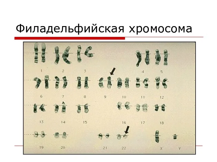 Филадельфийская хромосома