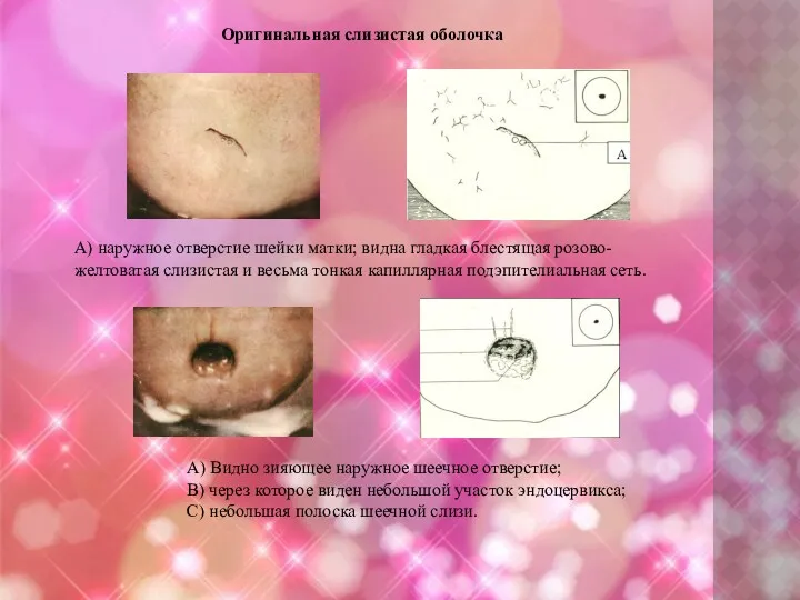 Оригинальная слизистая оболочка А) наружное отверстие шейки матки; видна гладкая