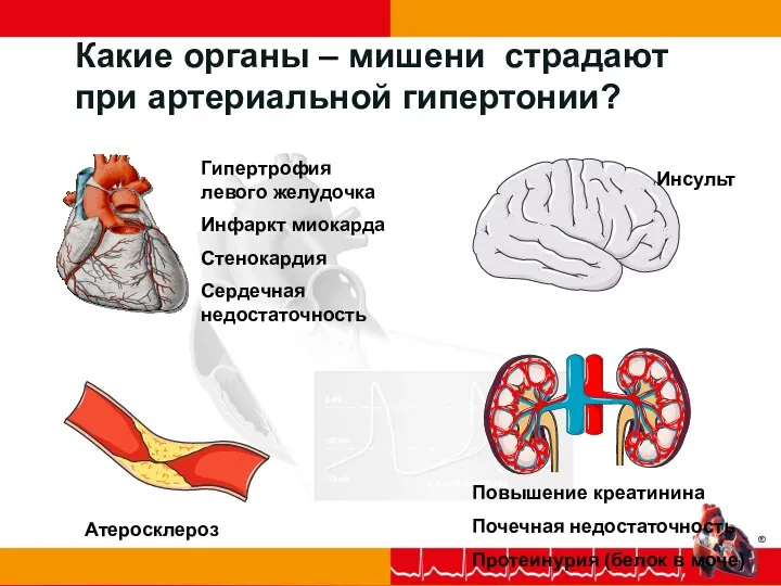 Какие органы – мишени страдают при артериальной гипертонии? Гипертрофия левого