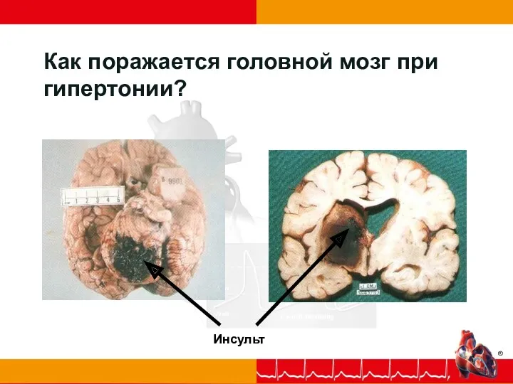 Как поражается головной мозг при гипертонии? Инсульт