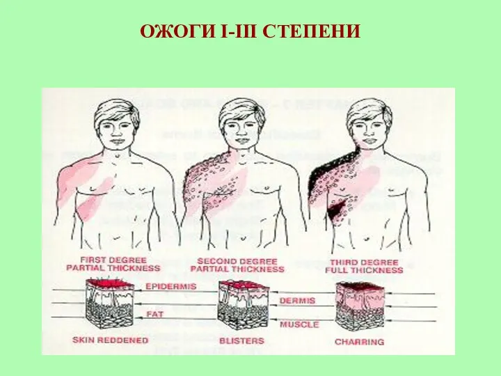 ОЖОГИ I-III СТЕПЕНИ