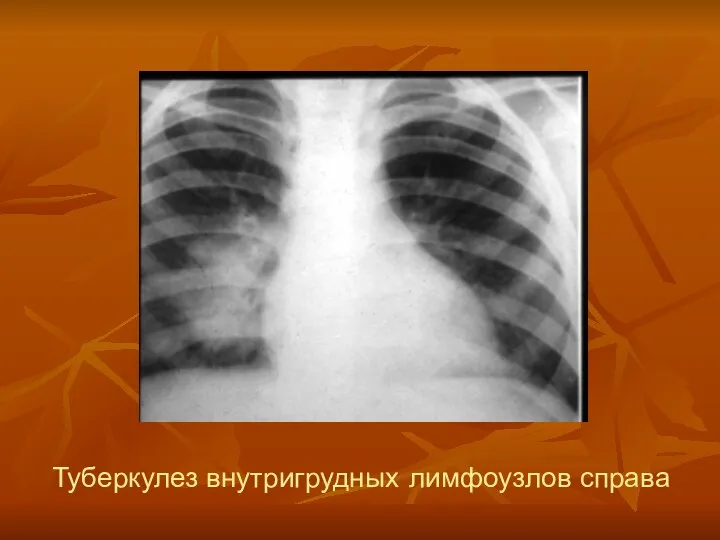 Туберкулез внутригрудных лимфоузлов справа