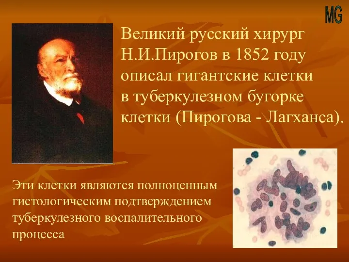 MG Великий русский хирург Н.И.Пирогов в 1852 году описал гигантские клетки в туберкулезном