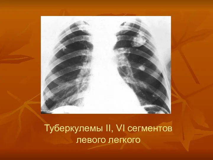 Туберкулемы II, VI сегментов левого легкого