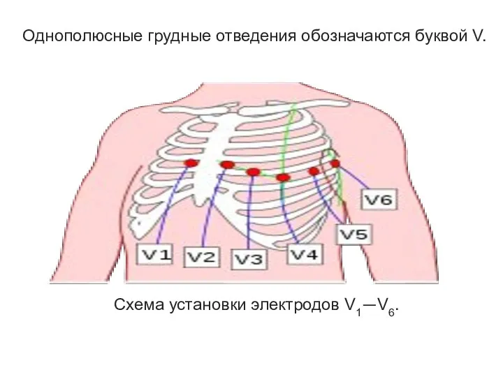 Однополюсные грудные отведения обозначаются буквой V. Схема установки электродов V1—V6.