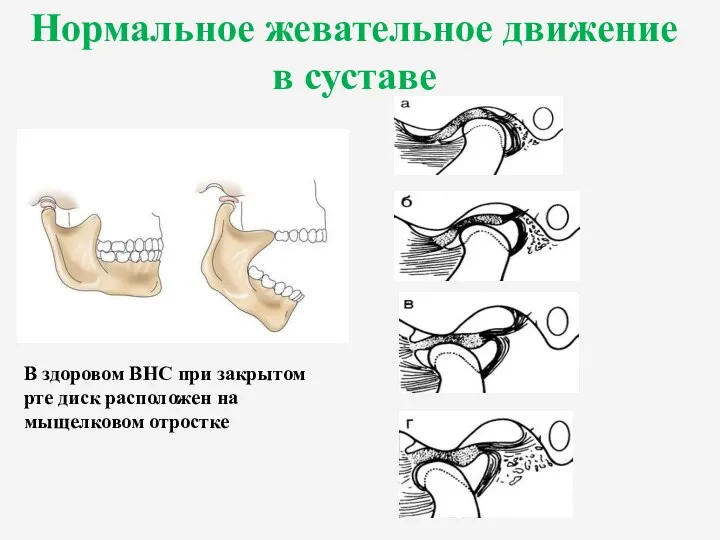 Нормальное жевательное движение в суставе В здоровом ВНС при закрытом рте диск расположен на мыщелковом отростке