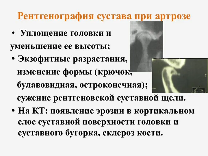 Рентгенография сустава при артрозе Уплощение головки и уменьшение ее высоты;