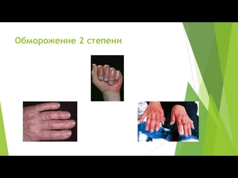 Обморожение 2 степени