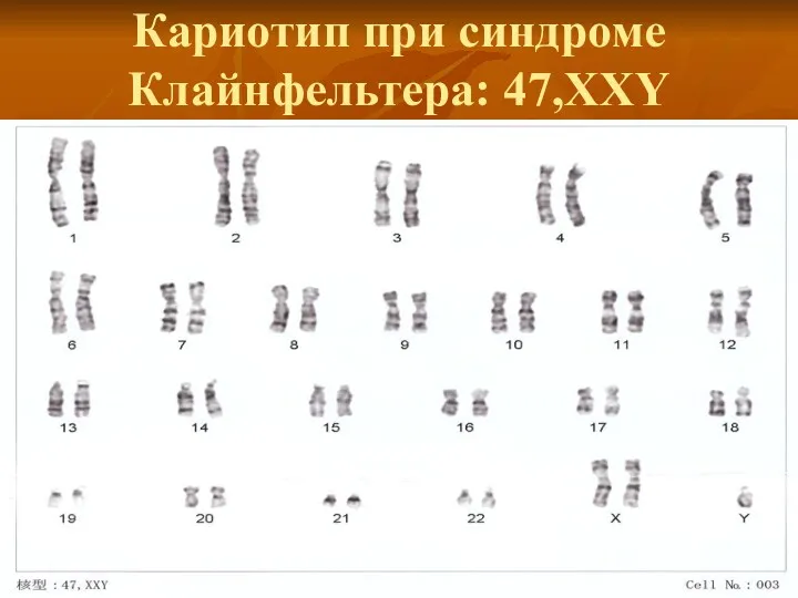 Кариотип при синдроме Клайнфельтера: 47,ХХY