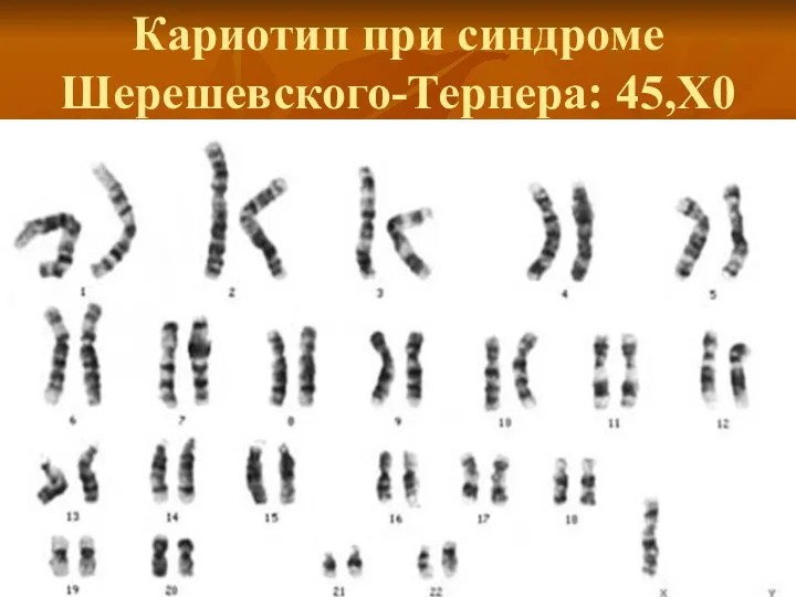 Кариотип при синдроме Шерешевского-Тернера: 45,Х0