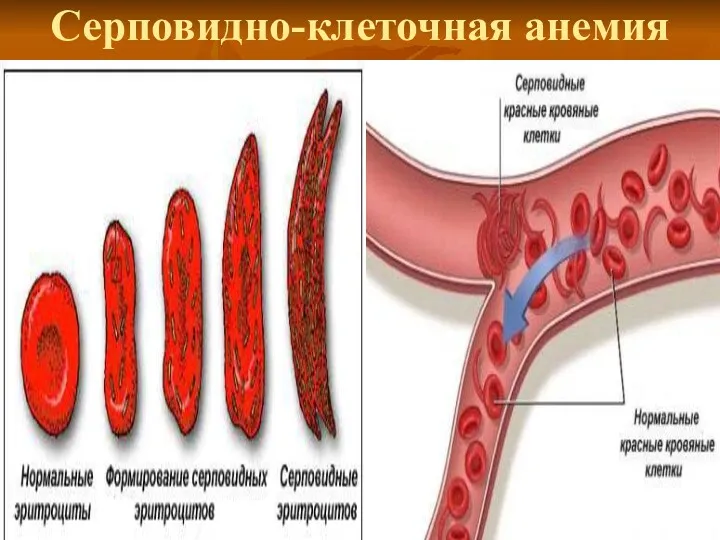 Серповидно-клеточная анемия