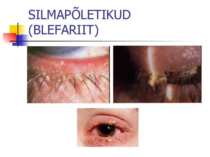 SILMAPÕLETIKUD (BLEFARIIT)