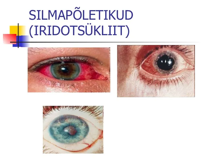 SILMAPÕLETIKUD (IRIDOTSÜKLIIT)