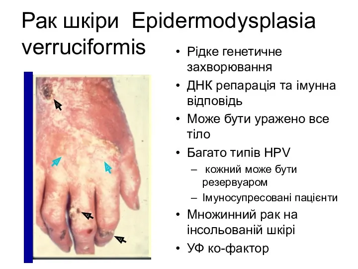 Рак шкіри Epidermodysplasia verruciformis Рідке генетичне захворювання ДНК репарація та