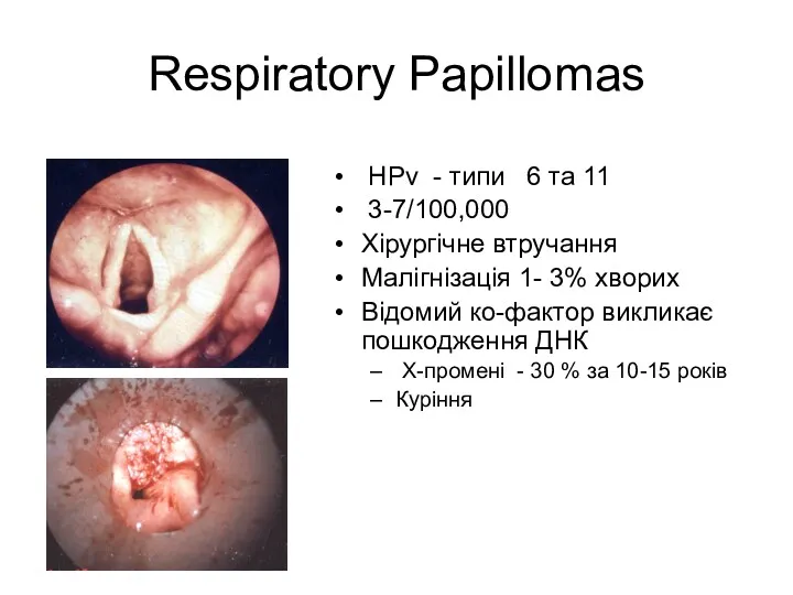 Respiratory Papillomas HPv - типи 6 тa 11 3-7/100,000 Хірургічне